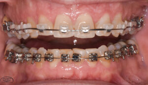 Orthodontic Specialty Services - Dr. Aron Dellinger Adult Orthodontics