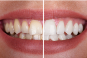Teeth Discoloration - Teeth 