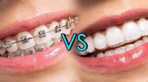 braces vs Invisalign