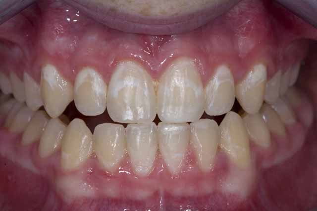 teeth spots braces why causes come