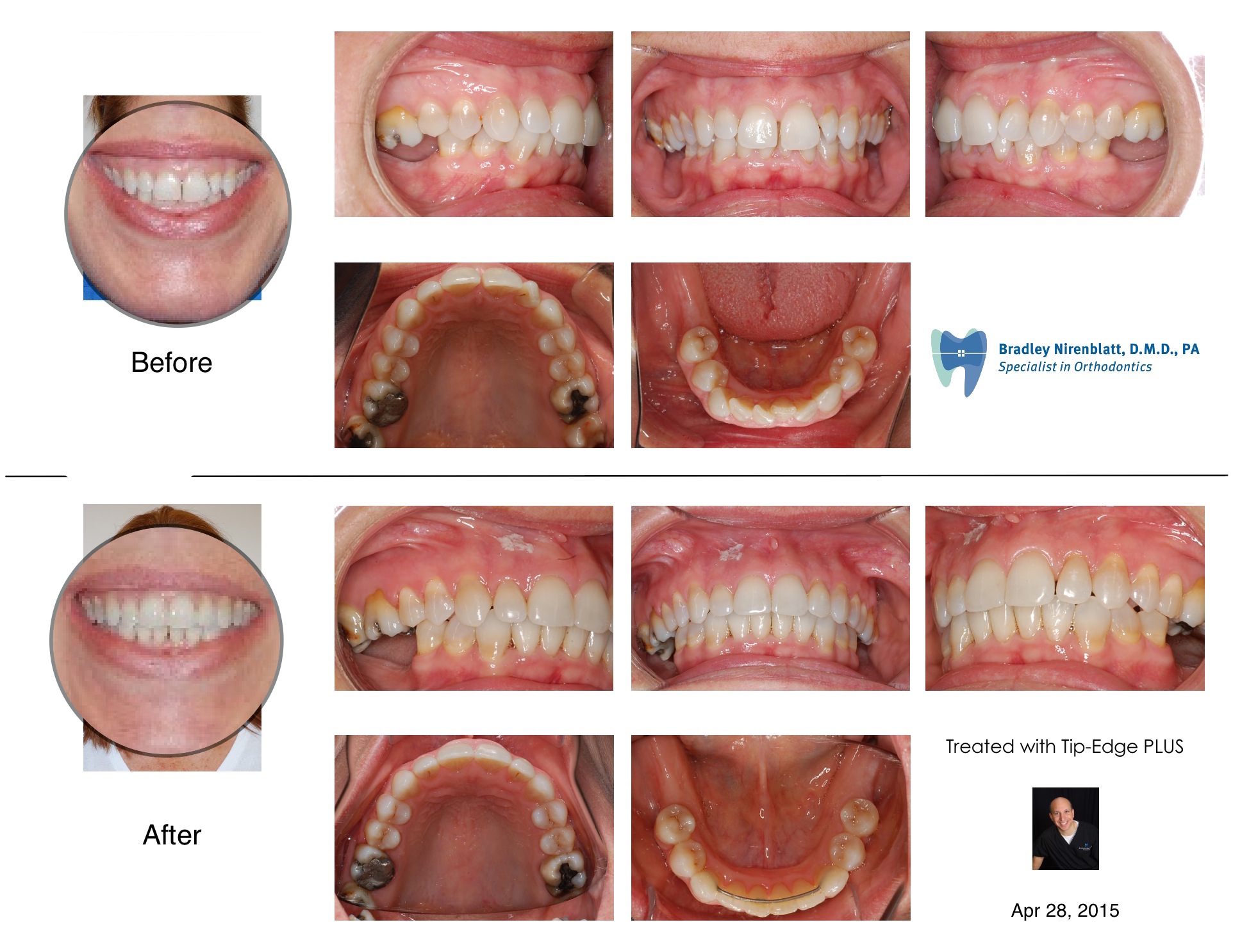 Adult Braces 