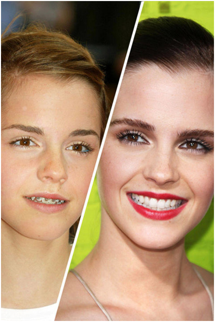 Stars With Braces Theyr