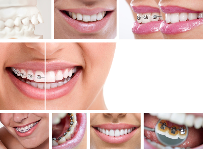 Don't Want Braces? Why not try Invisalign!
