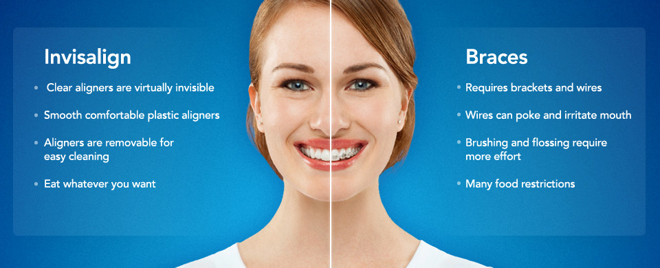 Why Invisalign® is the Best…!?