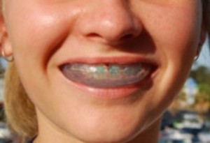 Mouthguard and Braces