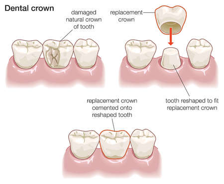 What S A Dental Crown