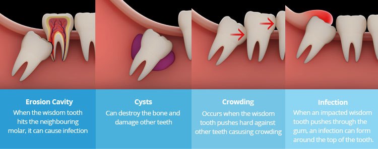 34 New Back wisdom tooth breaking apart 