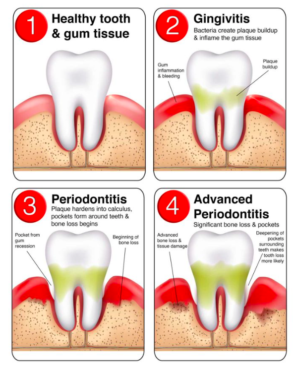 Snap Crackle Pop How Rheumatoid Arthritis Gum Disease Are Related