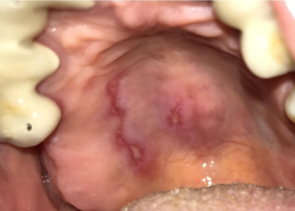 Possible Signs Of Covid 19 In The Mouth