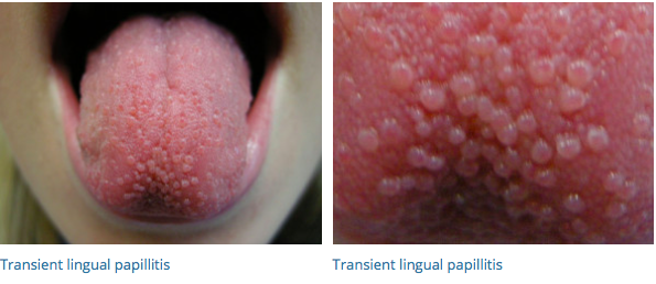 hypertrophic tongue papillae treatment papilloma virus herpes