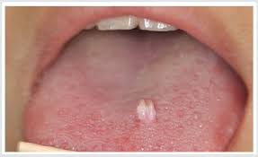 Enlarged tongue papillae treatment - Vallate papillae tongue treatment