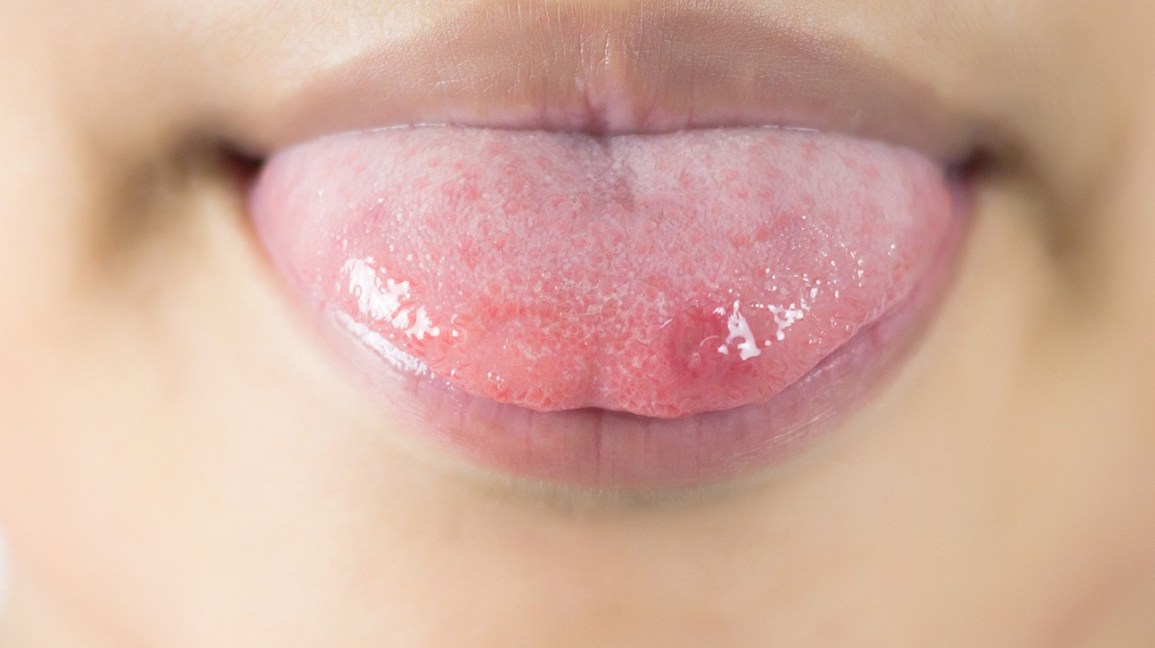 Can Candida Cause Lip Swelling