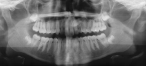 impacted canines, canine teeth, orthodontic therapy