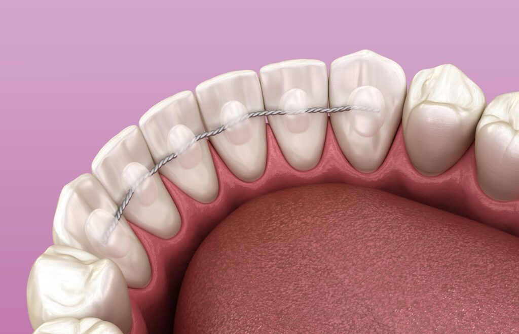 orthodontic treatment in Woodside 
