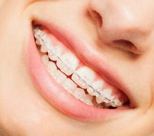 You're Never Too Old For Invisalign Clear Braces For Adults and Teens