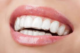 How Does Invisalign Work?  Invisible Braces Phoenix, AZ