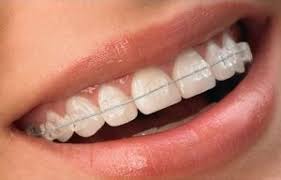 What different kinds of braces do orthodontists use? - Scottsdale