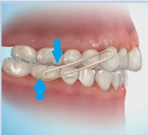 Braces Elastics (Rubber Bands) for Bite Correction and Alignment