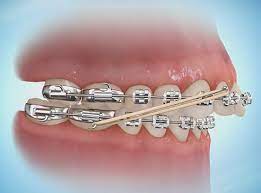 What Are Elastics for Braces? - Northenden House Orthodontics