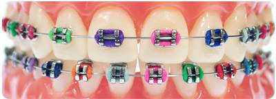 braces rubber color