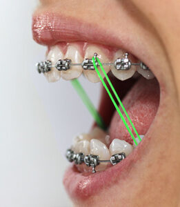 what do rubber bands do for braces