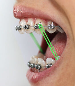 braces elastics overbite