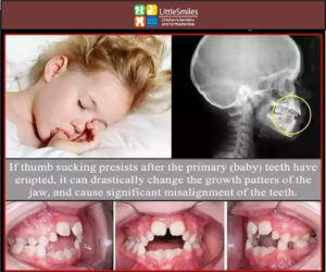 ways to stop sucking your thumb