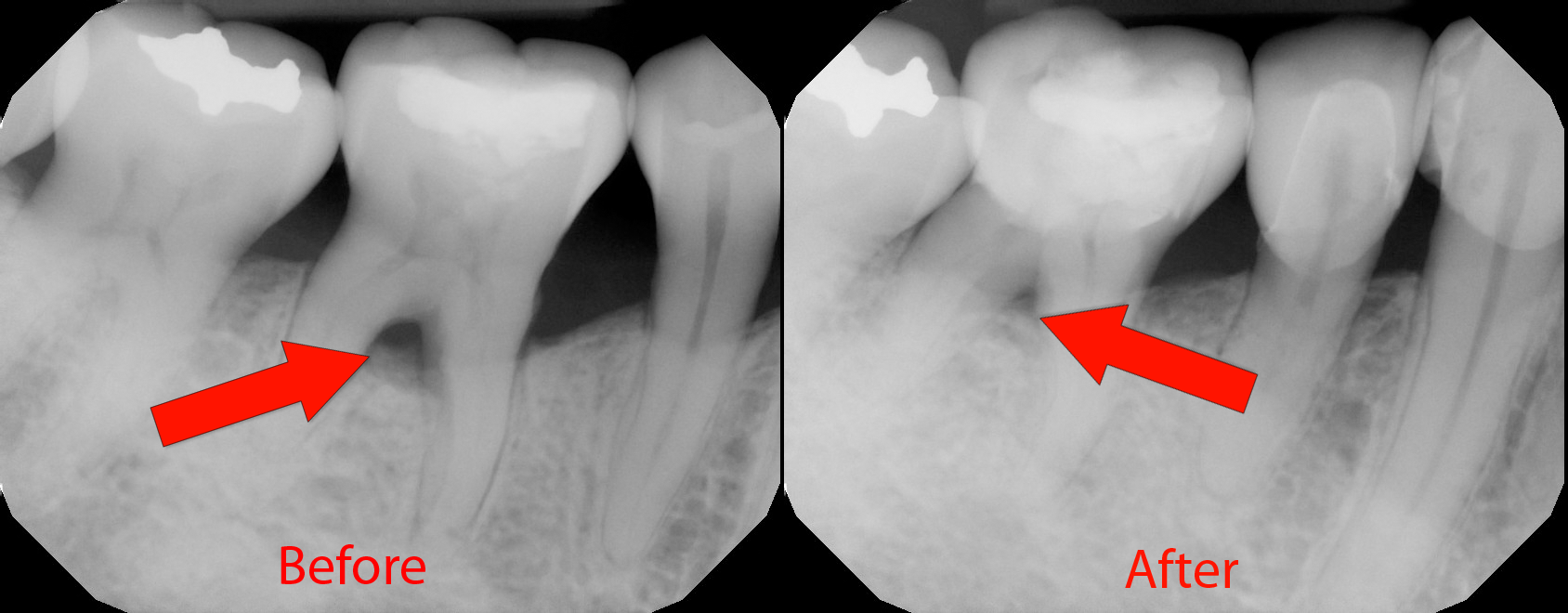 What Is Furcation In Dentistry at Lorrie Gooch blog