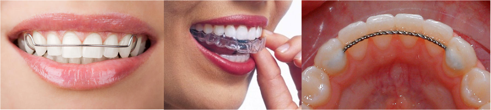 Which Type of Retainer Is Best for You?