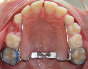 Common Problems with Orthodontic Expanders and How to Solve Them