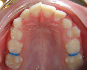 6 Common Questions About Palatal Expanders