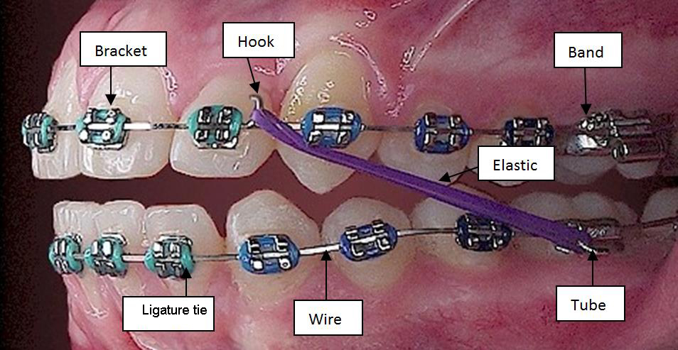 Parts of Braces: The Wire - Portland Braces