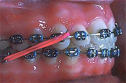 How to change the colorful rubber bands for orthodontics. Make sure to, Rubber Band Braces