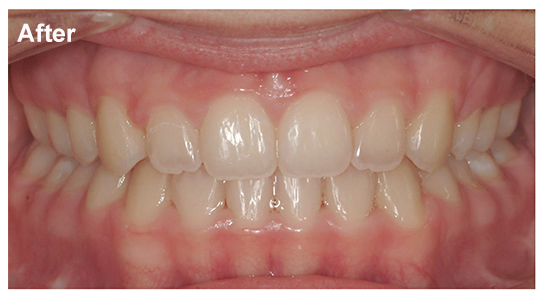 Mandibular Prognathism- The Royal Jaw