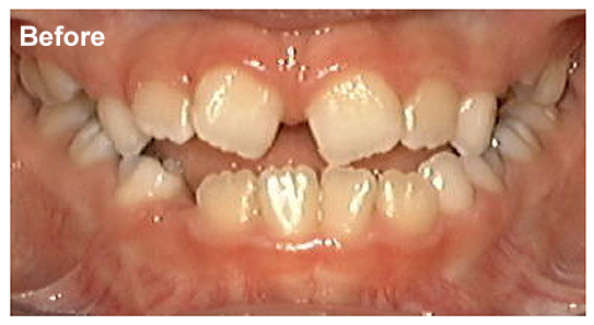 Habsburg jaw: mandibular prognathism