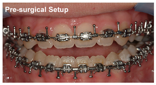 Mandibular Prognathism- The Royal Jaw