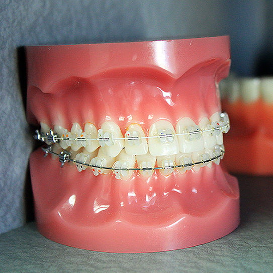 The History Of Braces