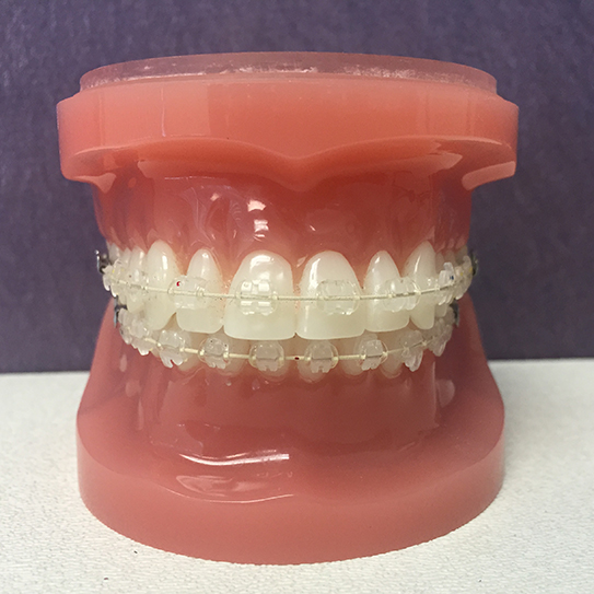 Ceramic (Clear) Braces  Cavalancia Orthodontics