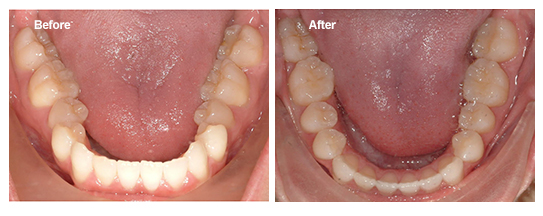 A Complete Guide to Teeth Widening - How to Achieve a Brighter and Whiter Smile