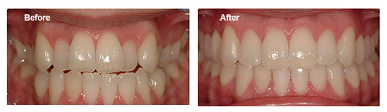 Overbite Correction - Broad Smiles Pediatric Dentistry