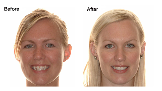 Invisalign - Harmonia Facial