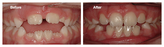 How Early Can I Close My Child's Open Bite?