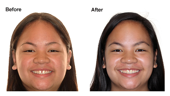 Frenectomy Before And After Smile
