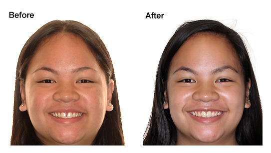 Labial Frenectomy Before And After 