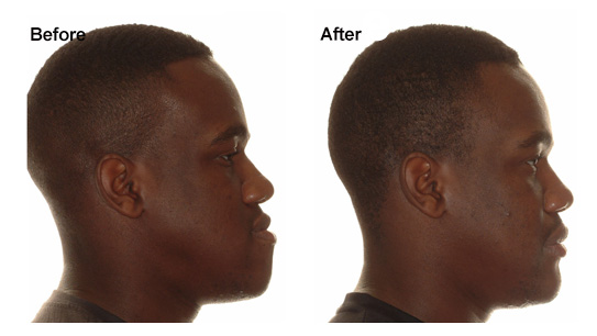 Mandibular Prognathism Before After