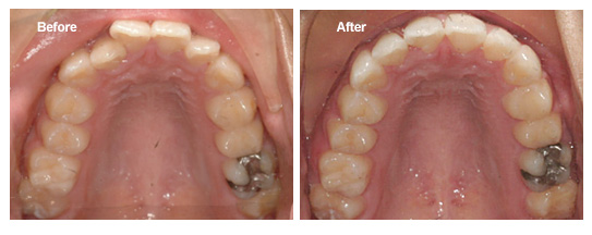 Spinach Teeth: Why Teeth Go Green