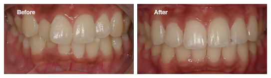 Spinach Teeth: Why Teeth Go Green