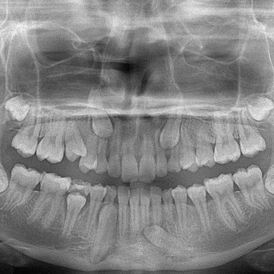 impacted teeth xray