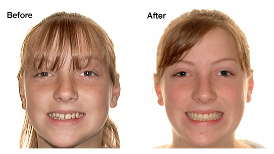 What Is the Best Age to Start Orthodontics? 