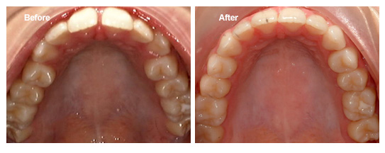 Right Age for Getting Orthodontic Treatment